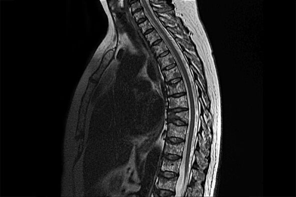 Manifestazioni dell'osteocondrosi toracica nel quadro della risonanza magnetica