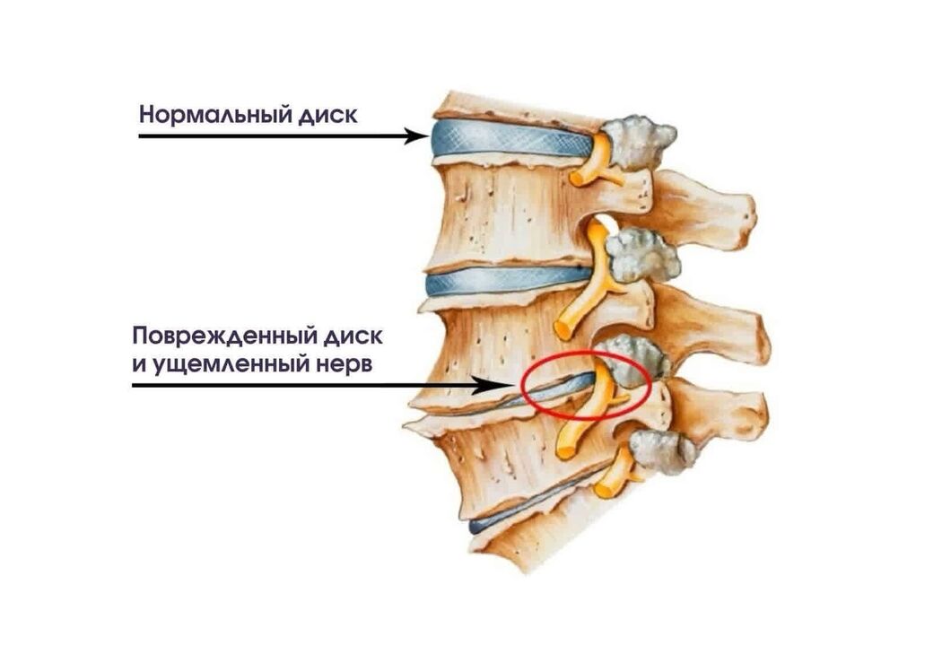 Sintomi di osteocondosi del collo
