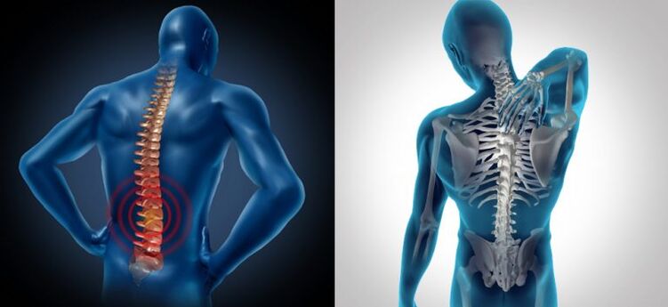 Infiammazione nell'osteocondrosi spinale