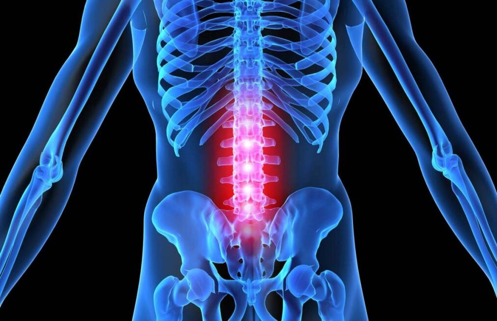 Osteocondrosi della colonna lombare