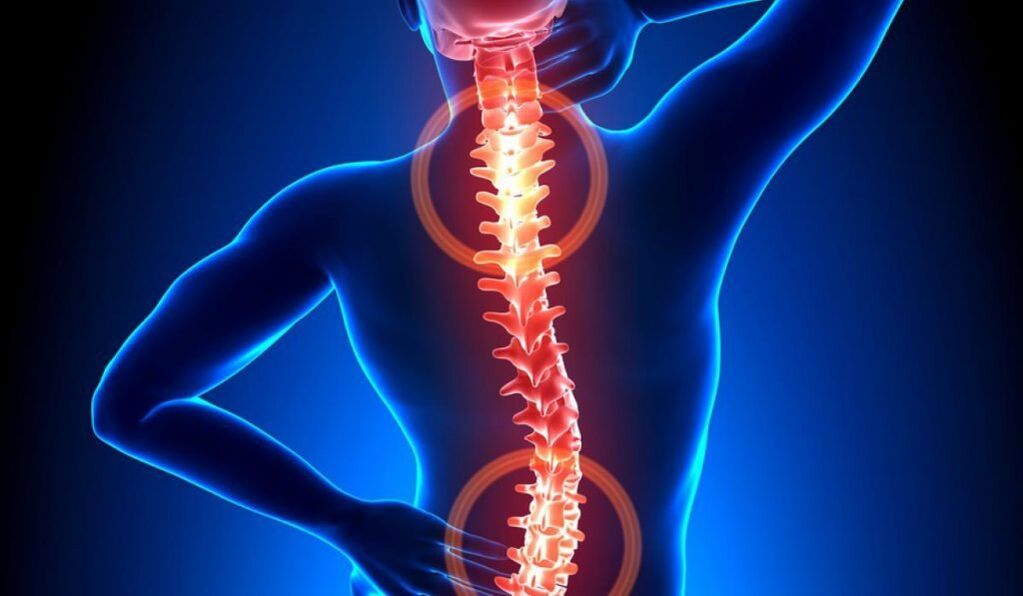 Osteocondrosi della colonna vertebrale