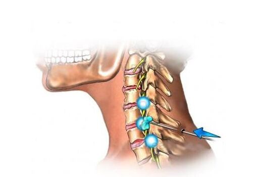 Trattamento dell'osteocondrosi cervicale